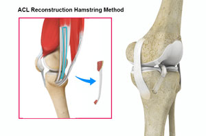 Hamstring Tendon