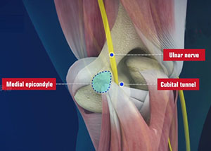 Ulnar Nerve Entrapment