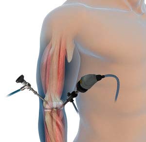 Elbow Arthroscopic and Open Surgery