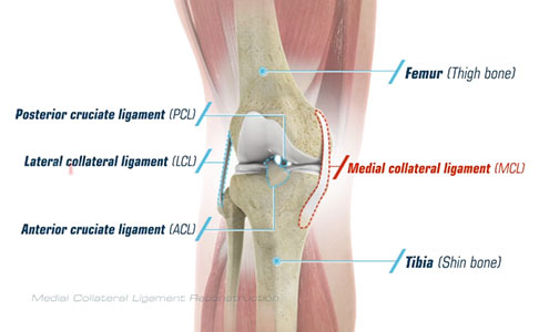 Anterior Cruciate Ligament (ACL) & Medial Collateral Knee Ligament (MCL)  Injuries