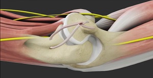 Elbow Ligament Reconstruction